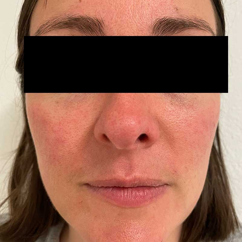 Couperose roodheid gezicht behandeling voor en na-foto